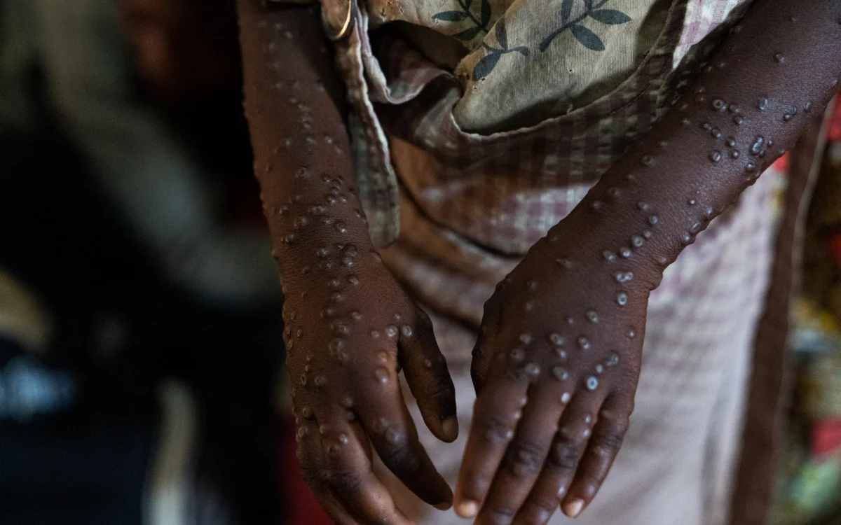 África tem quase 4 mil novos casos de mpox em uma semana, mas ainda não recebeu vacinas